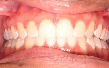 Faith - an image of teeth after braces treatment | Awbrey Orthodontics - Alpharetta