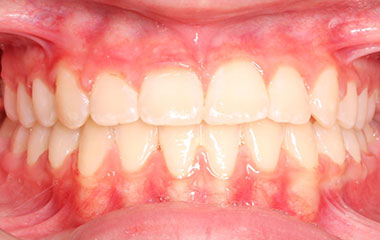 Presley - an image of teeth after braces treatment | Awbrey Orthodontics - Alpharetta