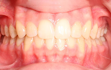 Bella - an image of teeth after Invisalign aligner treatment | Awbrey Orthodontics - Alpharetta