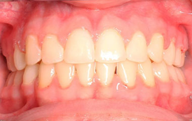 Brooks - an image of teeth after Invisalign aligner treatment | Awbrey Orthodontics - Alpharetta