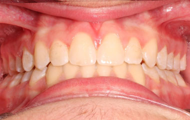 Max - an image of teeth after Invisalign aligner treatment | Awbrey Orthodontics - Alpharetta