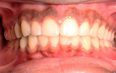 Orsinor - Image of Teeth After Invisalign Results | Awbrey Orthodontics