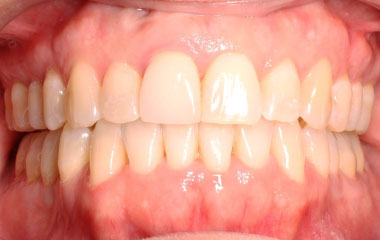Suzanne - Image of Teeth After Invisalign Results | Awbrey Orthodontics