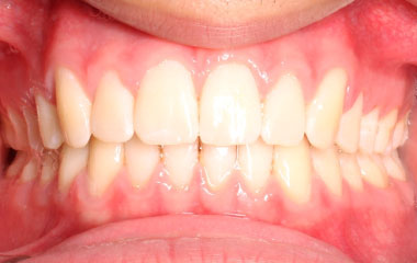 Zeid - Image of Teeth After Invisalign Results | Awbrey Orthodontics