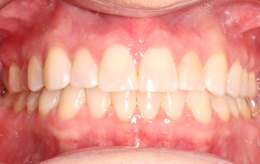 Garrett - Image of Teeth After Invisalign Results | Awbrey Orthodontics
