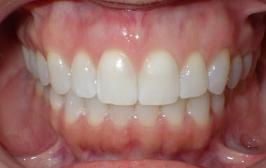 Judy - an image of teeth after Smile Express at home aligners | Awbrey Orthodontics - Alpharetta