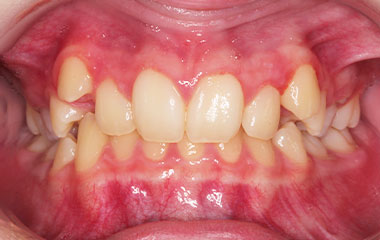 Katherine - an image of teeth before braces treatment | Awbrey Orthodontics - Alpharetta