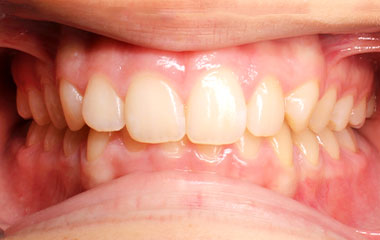 Bella - an image of teeth before Invisalign aligner treatment | Awbrey Orthodontics - Alpharetta