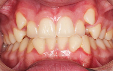 Brooks - an image of teeth before Invisalign aligner treatment | Awbrey Orthodontics - Alpharetta
