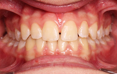 Max - an image of teeth before Invisalign aligner treatment | Awbrey Orthodontics - Alpharetta