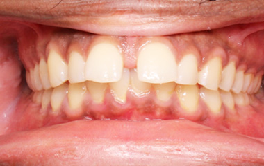 Orsinor - Image of Teeth Before Invisalign Results | Awbrey Orthodontics