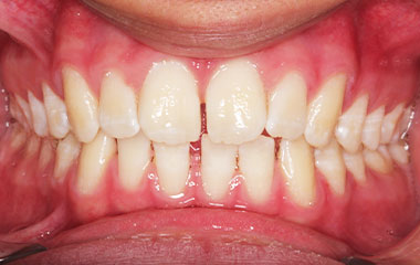 Zeid - Image of Teeth Before Invisalign Results | Awbrey Orthodontics