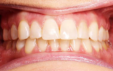 Garrett - Image of Teeth Before Invisalign Results | Awbrey Orthodontics