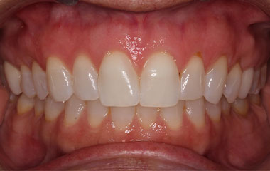Judy - an image of teeth before Smile Express at home aligners | Awbrey Orthodontics - Alpharetta