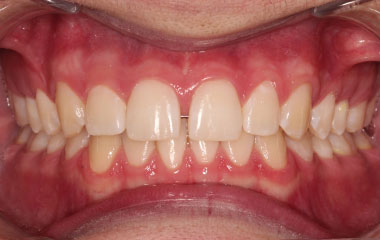 Matt - an image of teeth before Smile Express at home aligners | Awbrey Orthodontics - Alpharetta