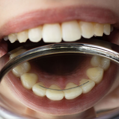 Fixed orthodontic retainers | Awbrey Orthodontics - Alpharetta